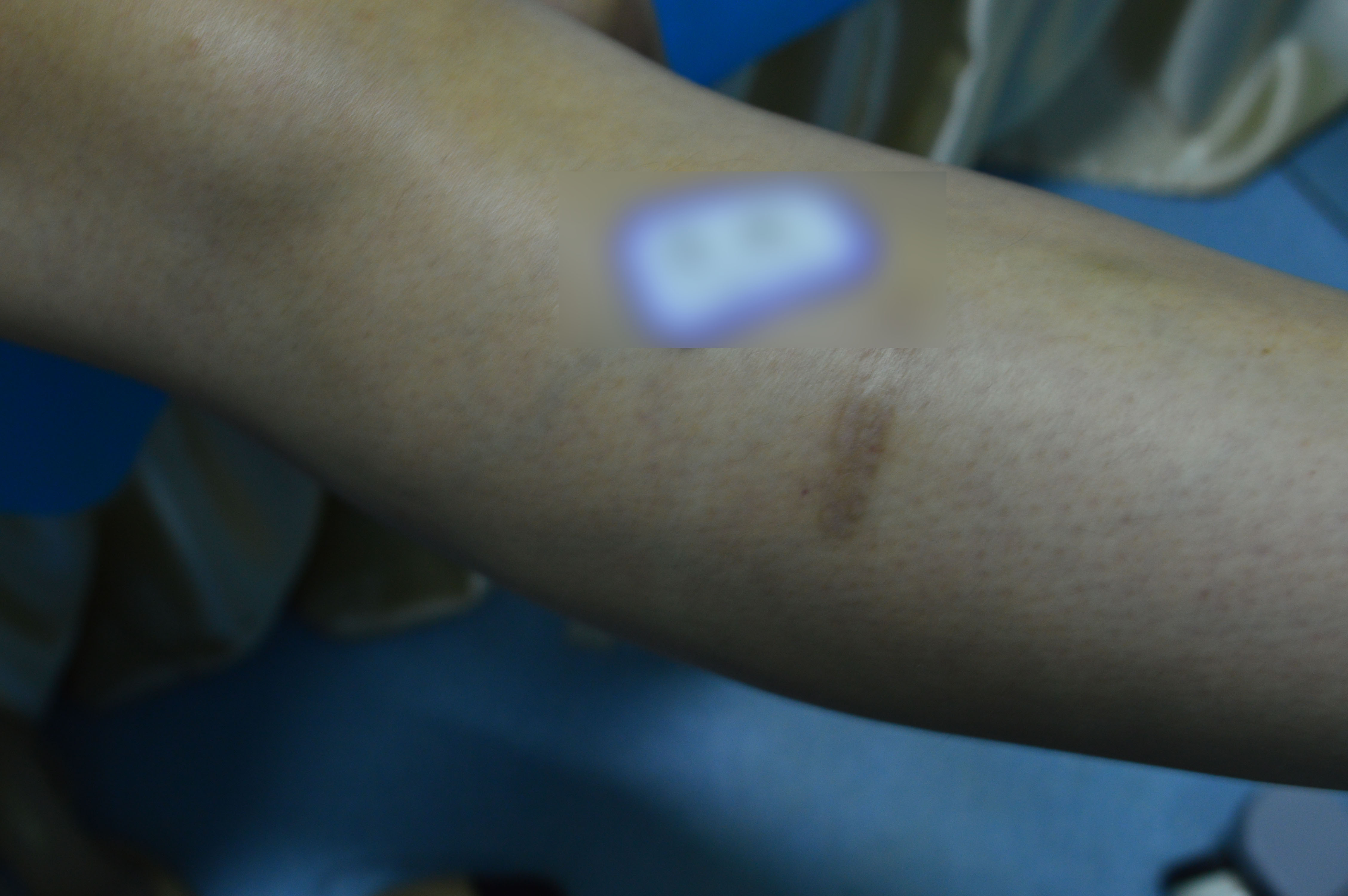 色素缺失的白色疤痕要怎麼調整？