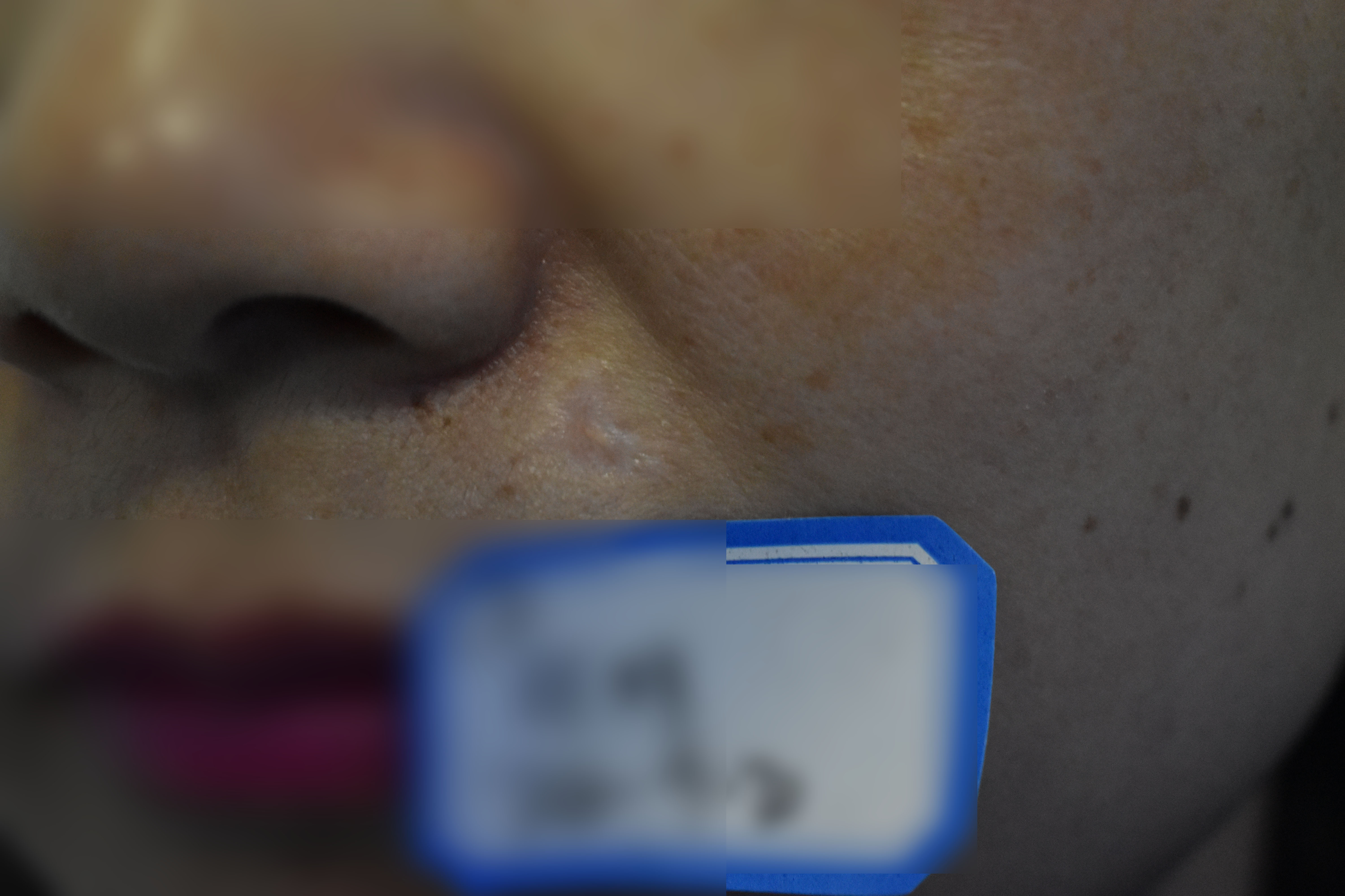 點痣後增生凸起怎麼辦?