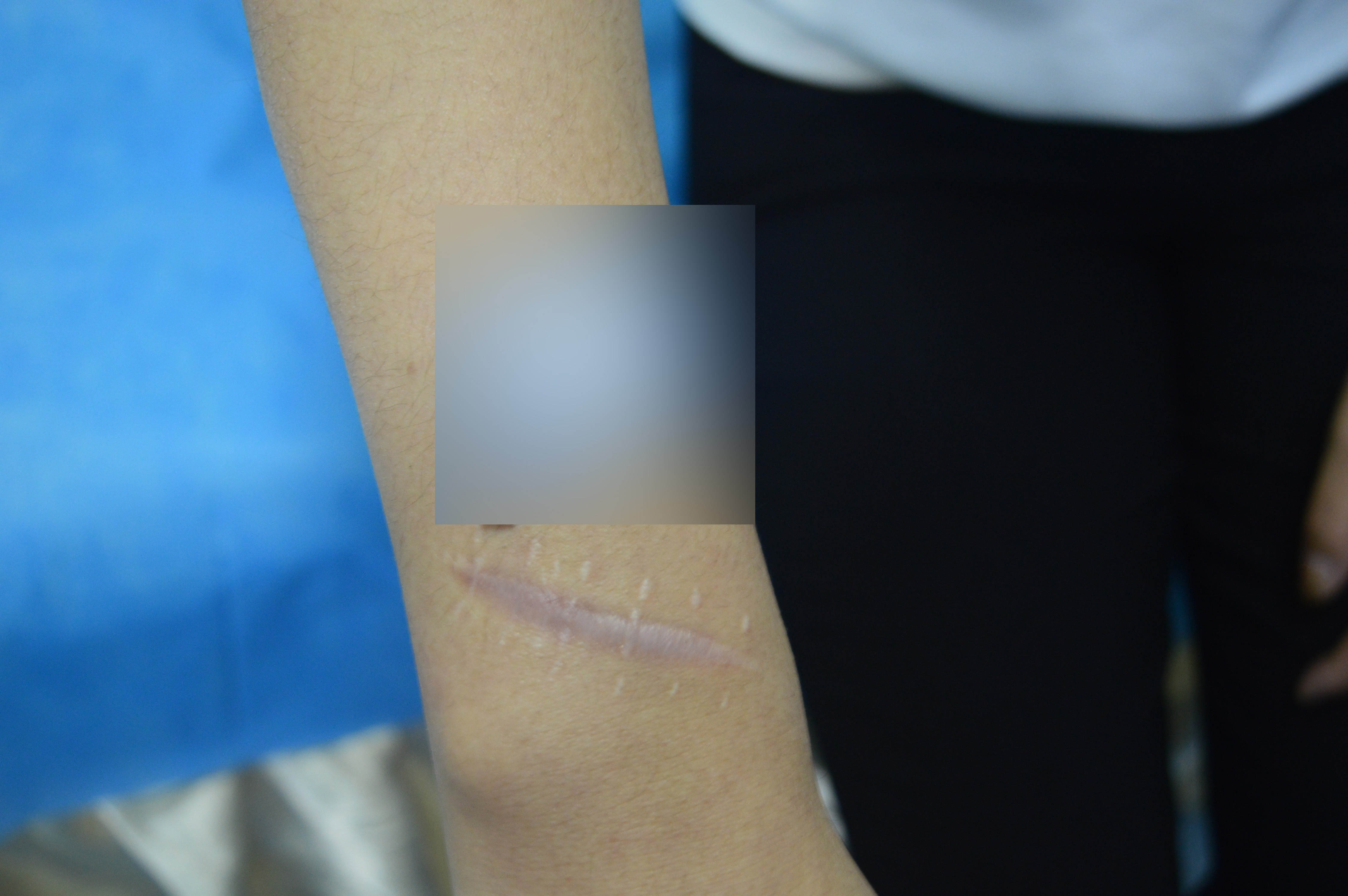 手術疤痕修復的最佳時間？