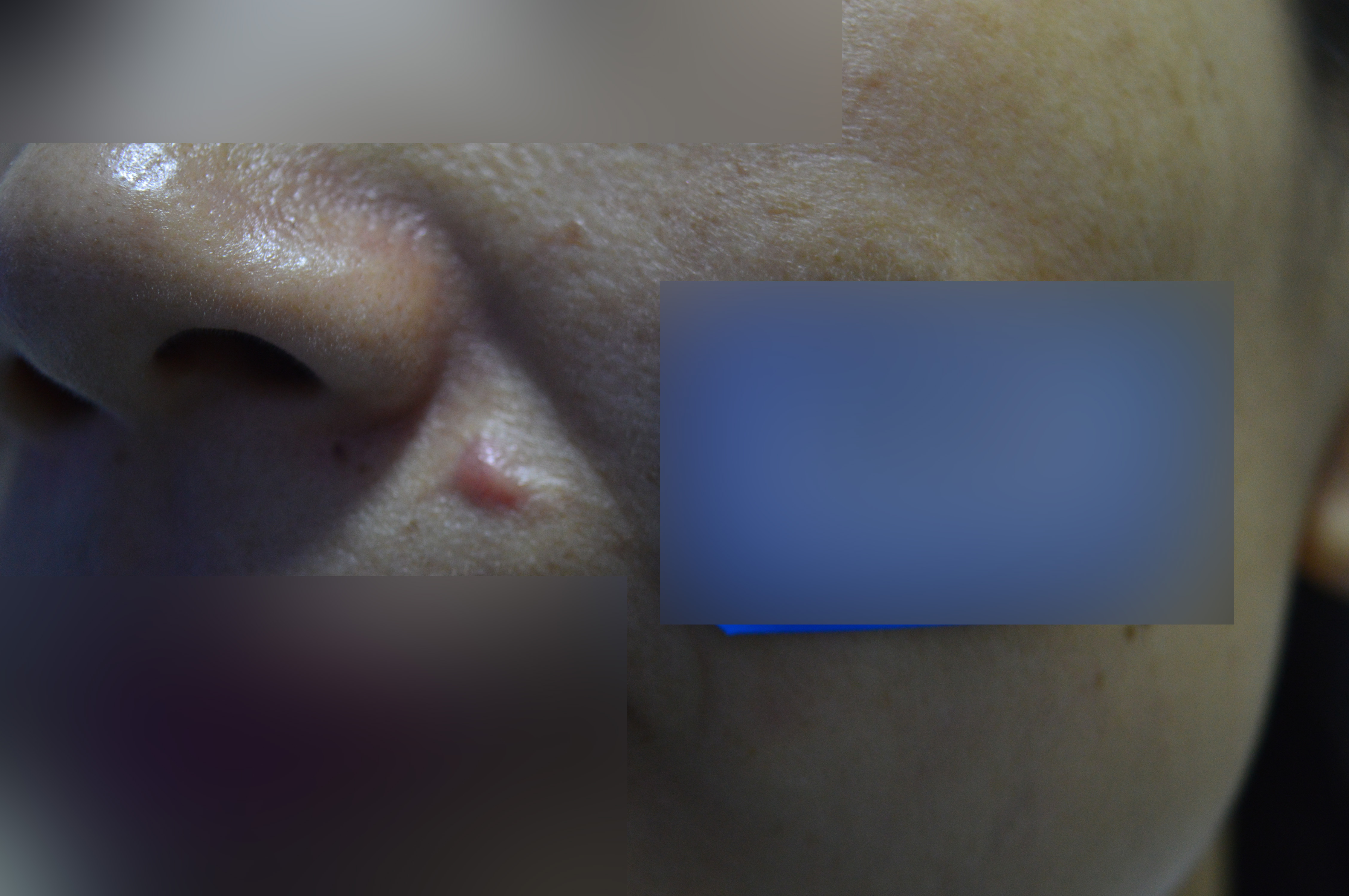 點痣後疤痕多久消失?