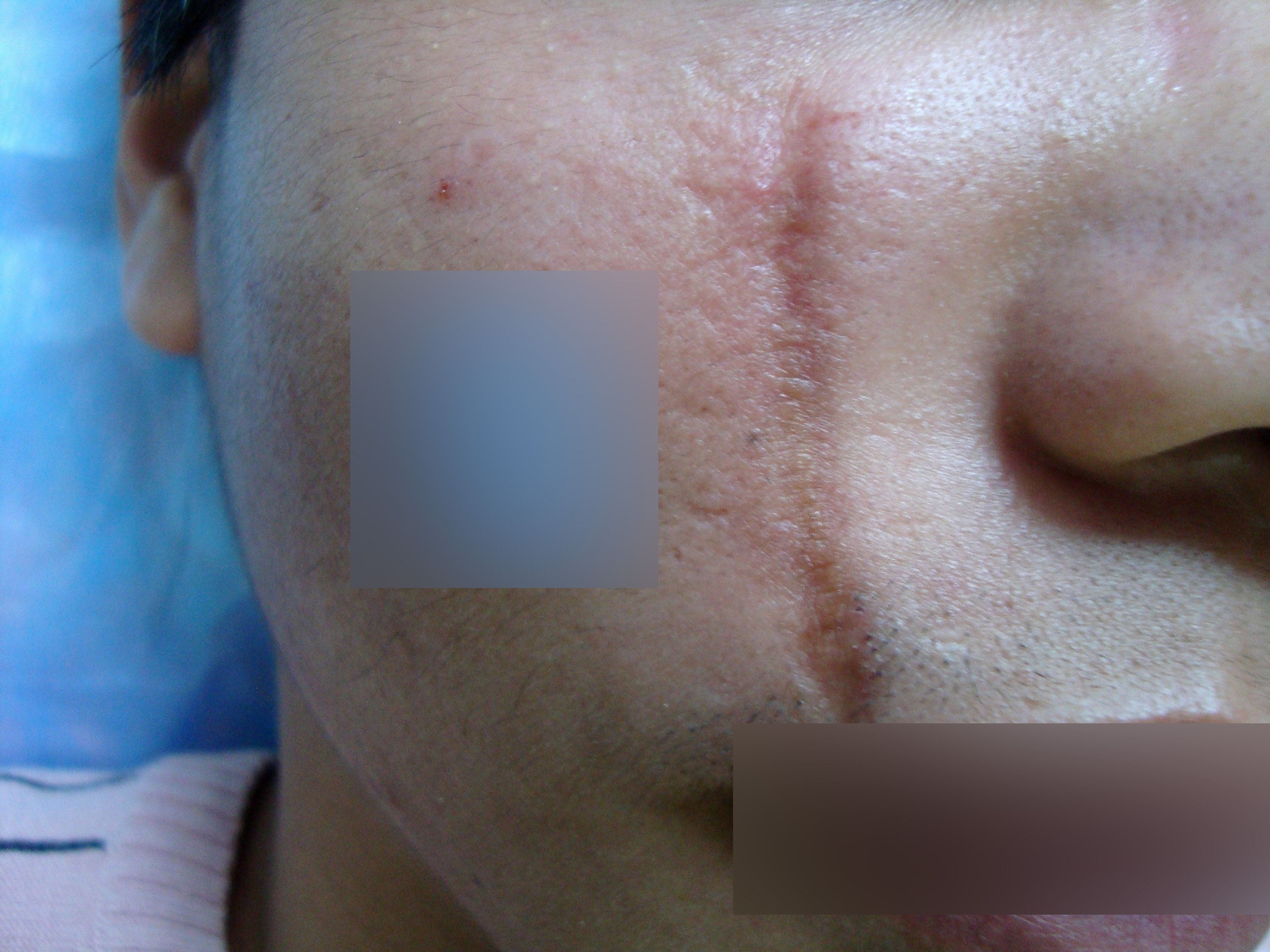 外傷疤痕紅印怎麼辦？