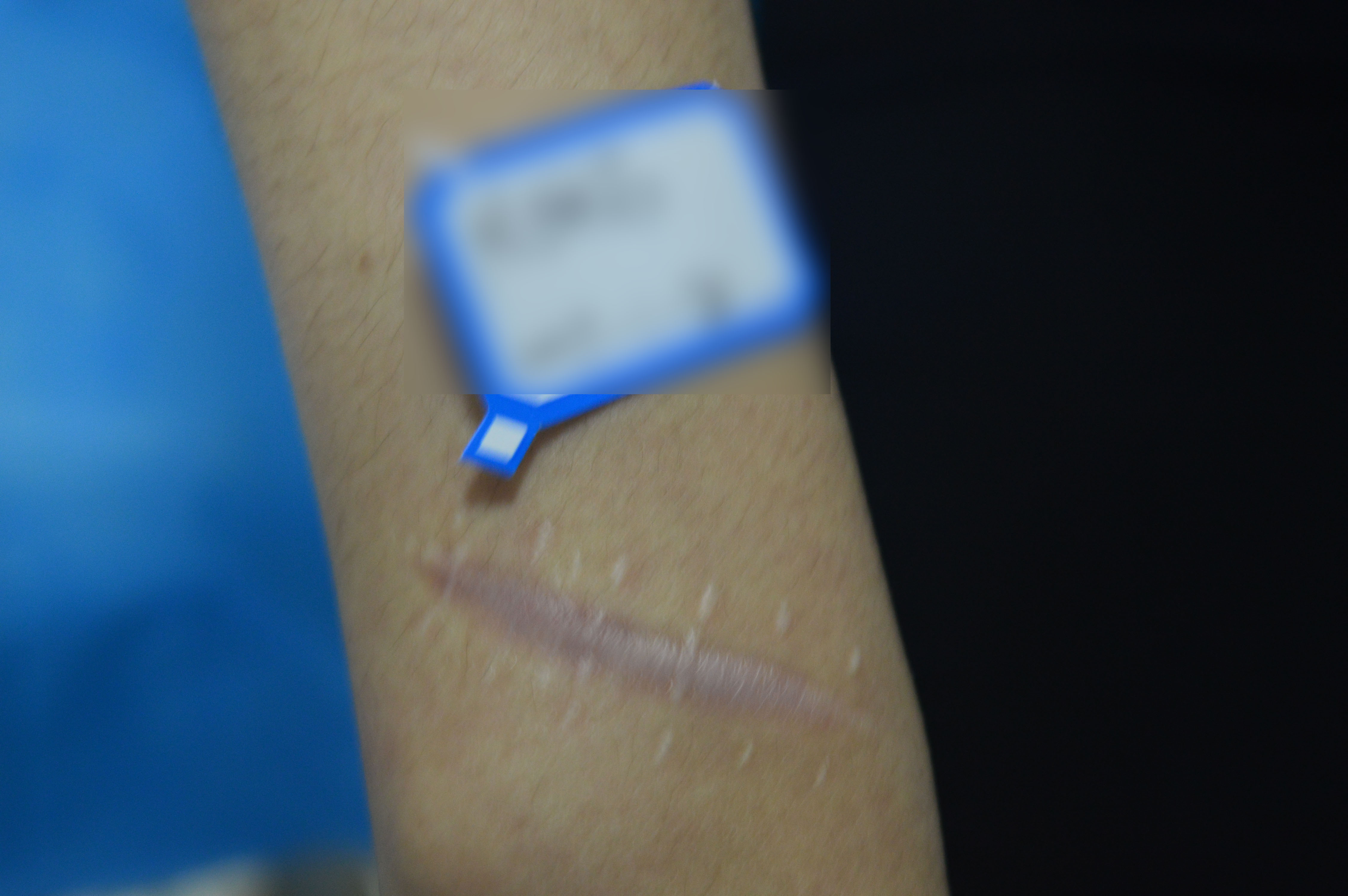 手術刀口鼓起怎麼辦？