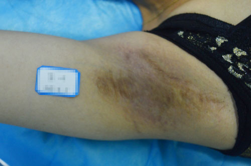 腋臭手術後需要休息幾天?