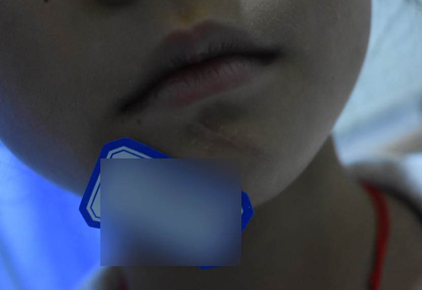 不到十歲的孩子手術縫針怎麼做才能不留疤痕？