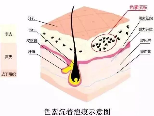 傷口癒合後，為什麼會出現色素沉着？