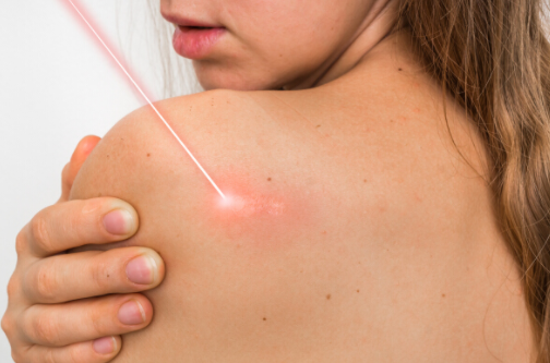 點痣後,留下疤痕怎麼辦?