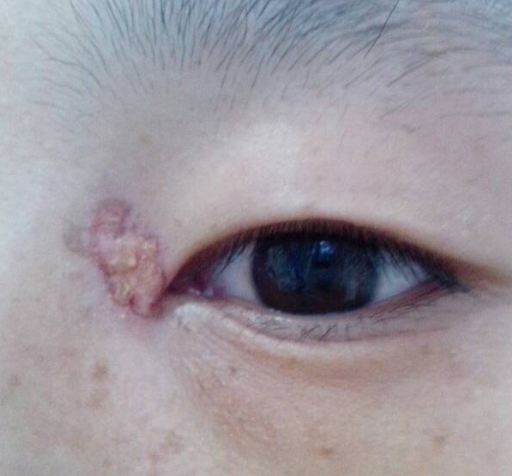 眼角疤痕可以修復嗎？修複方法有哪些呢？