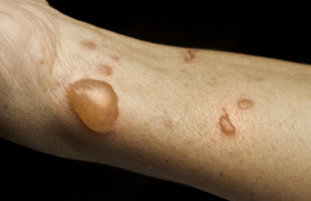 不小心燙傷後需要注意哪些？