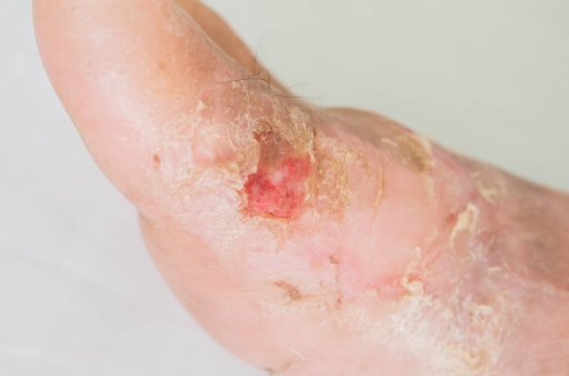 糖尿病患者的皮膚被意外燒燙傷應該怎麼樣處理？