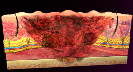 針對大面積燒燙傷創面的處理原則