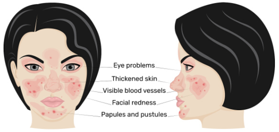 面部燒傷後早期疤痕治療的護理干預
