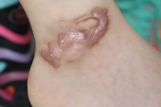 整形修復足部深度燒傷疤痕