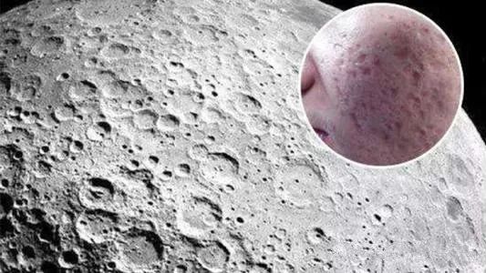 常見的治療青春痘疤痕的方法?