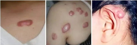 疤痕疙瘩與疤痕體質之間的關係