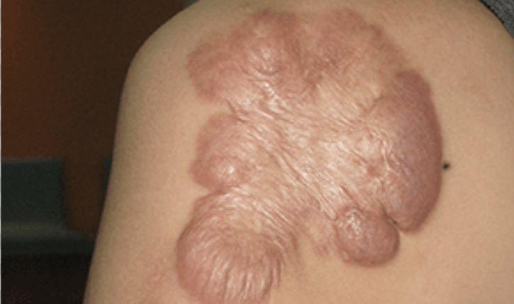 凹凸疤痕修復有哪些方法？