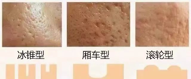 痘印到底是怎麼產生的呢？