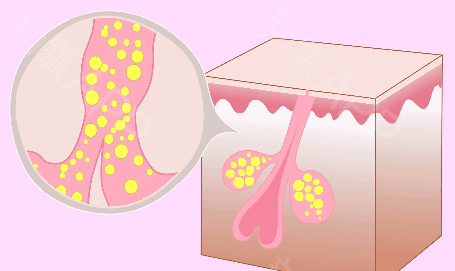 脖子上長痘是因為什麼？