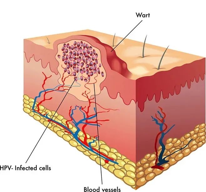 痤瘡的致病原因有哪些
