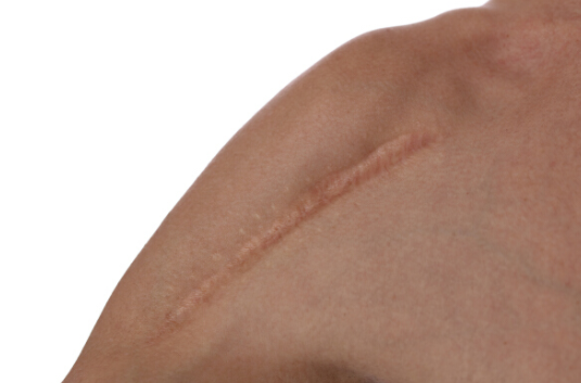 看到這4大危害，你還想用紋身來遮蓋疤痕嗎？