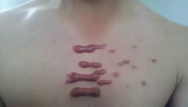 疤痕體質、疤痕疙瘩，有什麼不同？