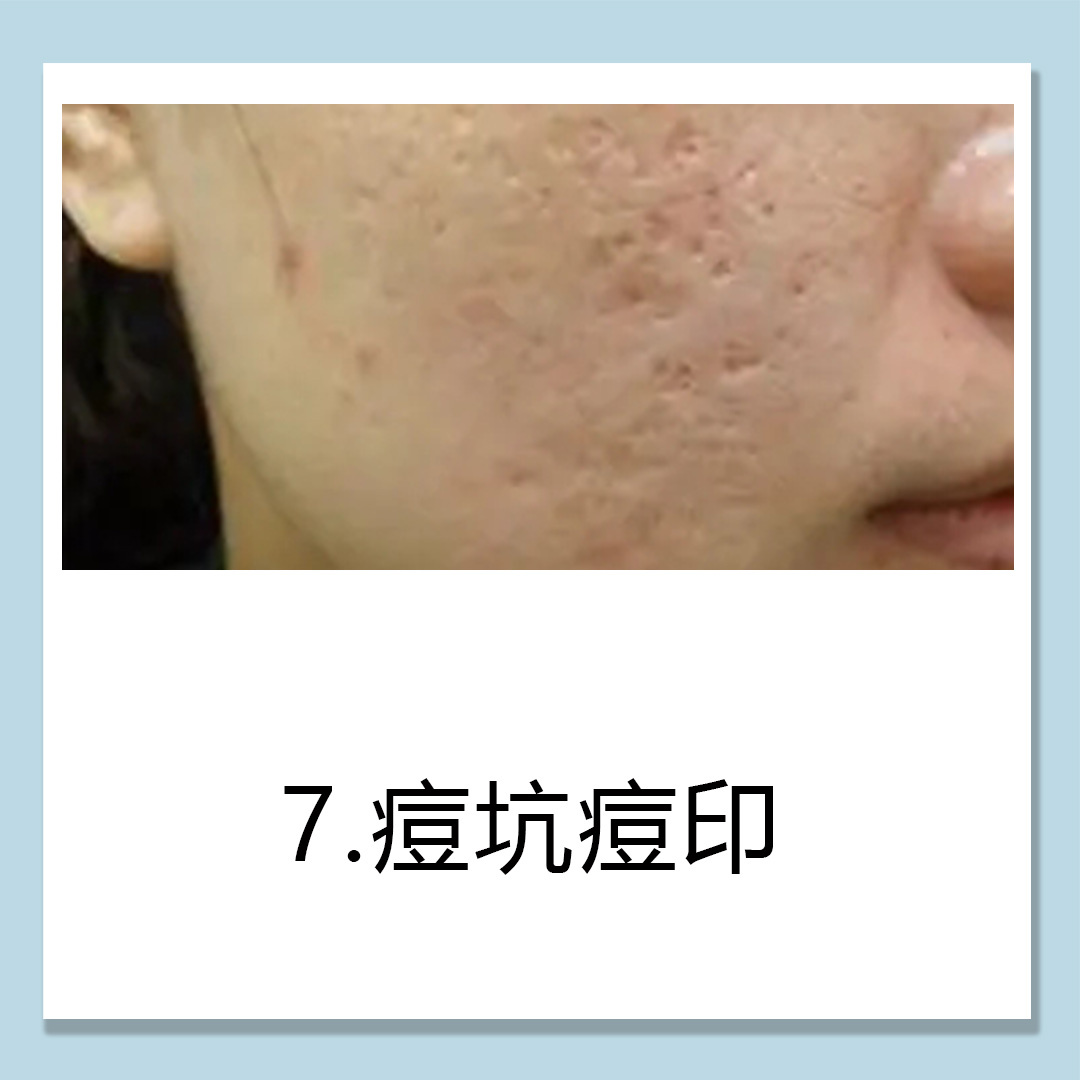 預防痤瘡的7個小貼士