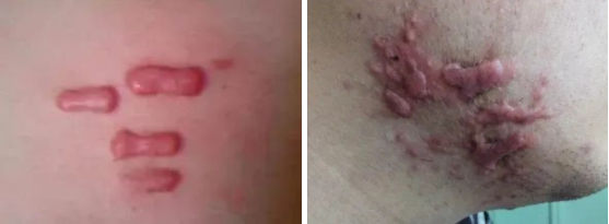 原髮型疤痕疙瘩是怎麼回事