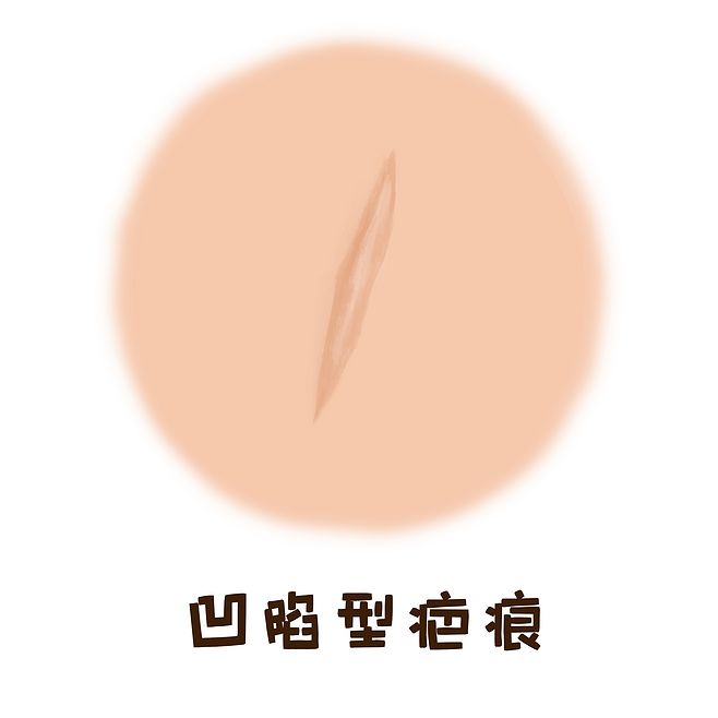 怎麼修復額頭凹陷疤痕