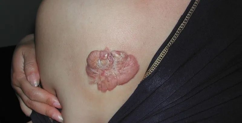 疤痕增生怎麼辦