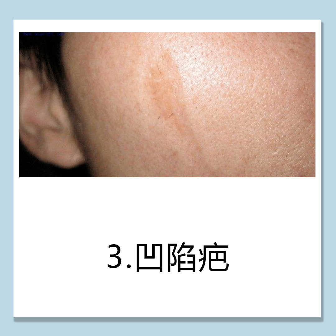 凹陷型疤痕要怎樣去除？