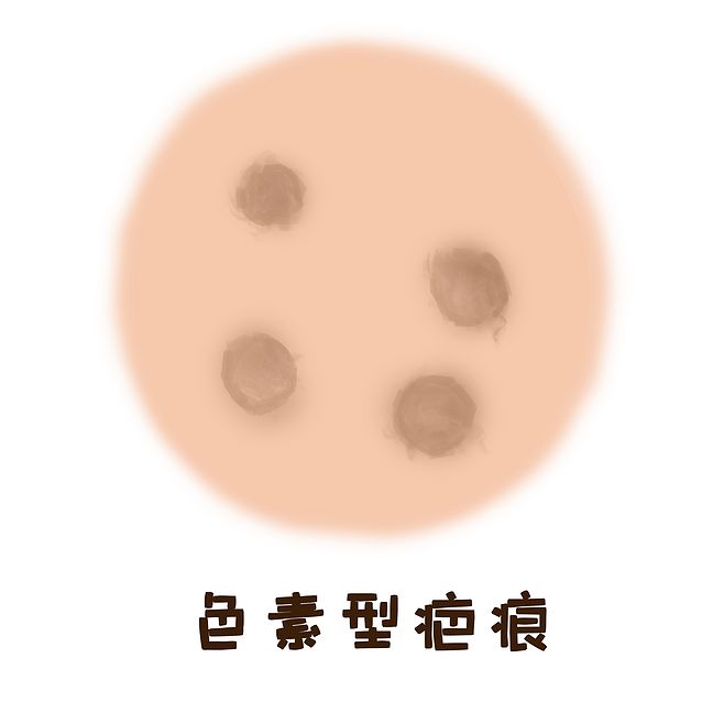 疤痕修復中色素疤痕的形成因素種類