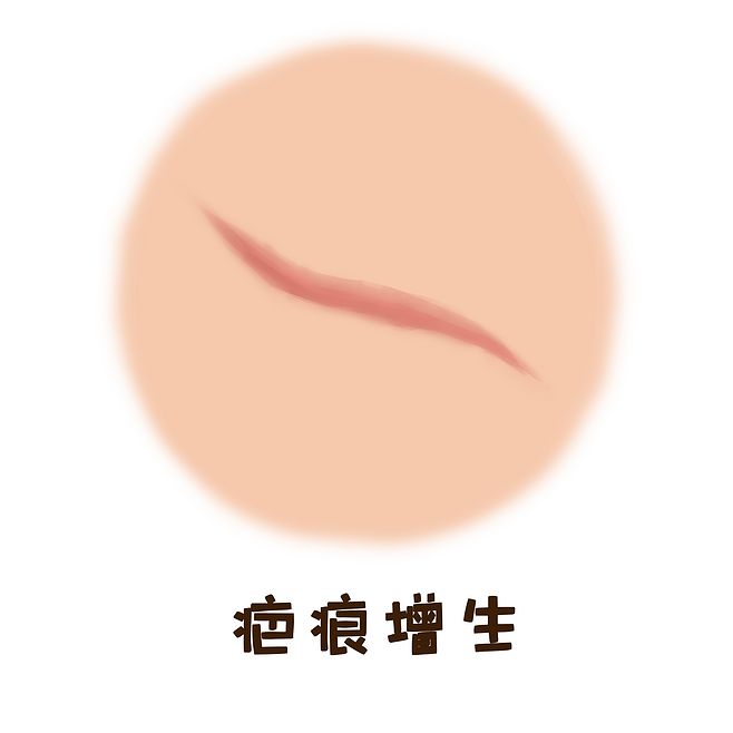 疤痕增生的治療要注意什麼？