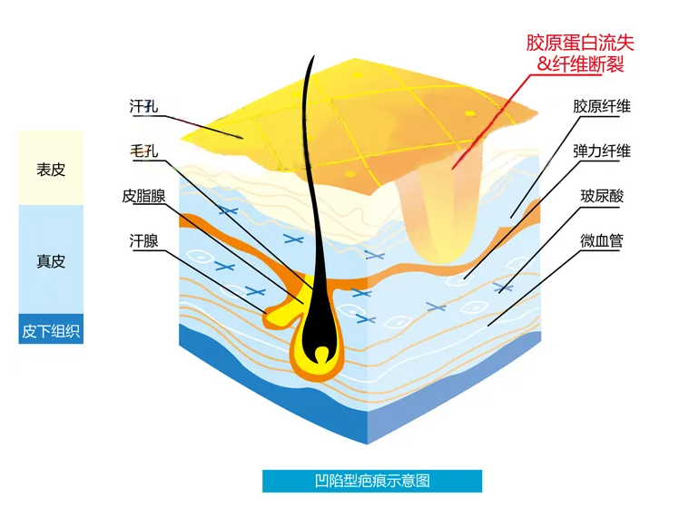 點痣後留疤怎麼辦？