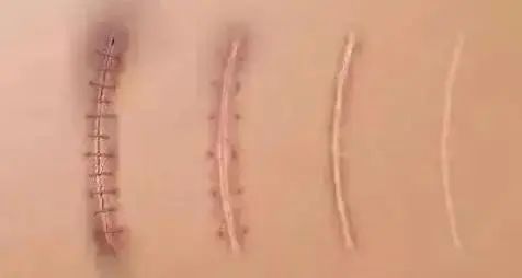 深色食物會讓整形傷口變黑嗎