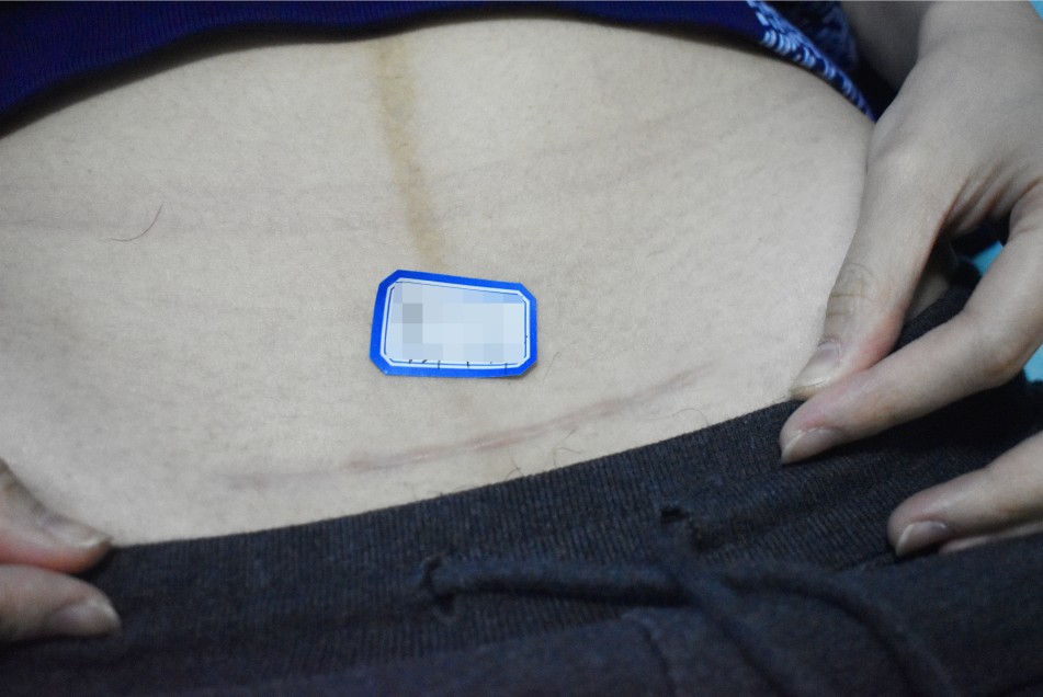 縫針疤痕幾年後可以淡化？