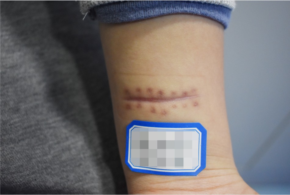 傷口縫針和不縫針的區別？