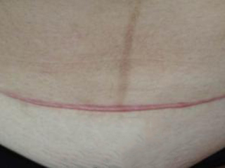 深圳剖腹產疤痕如何修復